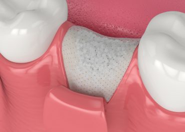 3D render of dental bone grafting with bone biomaterial and membrane over white background. Jaw bone augmentation concept.